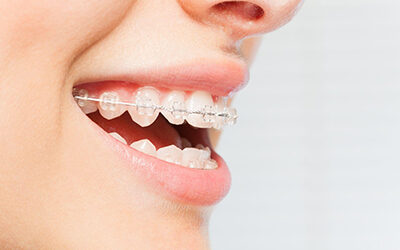 Clear braces